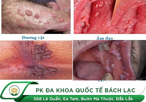 U nhú sinh dục là gì?