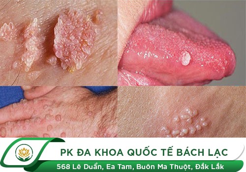 BỆNH SÙI MÀO GÀ Ở MIỆNG
