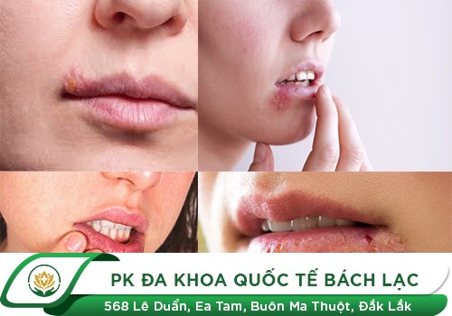 Hình ảnh bệnh mụn rộp sinh dục ở miệng, môi, mắt