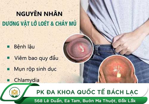 LOÉT DƯƠNG VẬT LÀ TRIỆU CHỨNG CỦA BỆNH GÌ?