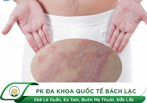 Nổi mụn ở bìu là dấu hiệu của bệnh lý gì?