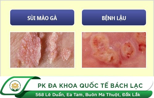Kiểm tra xem bạn có những dấu hiệu mắc bệnh ở dương vật hay không