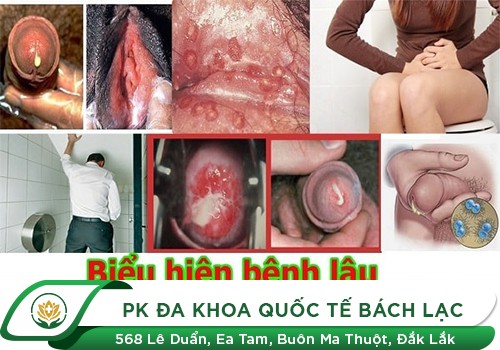 Đi tiểu nóng rát, dương vật chảy mủ dấu hiệu của bệnh gì?