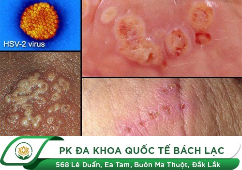 Nguyên nhân mắc bệnh lây truyền qua đường tình dục là gì?