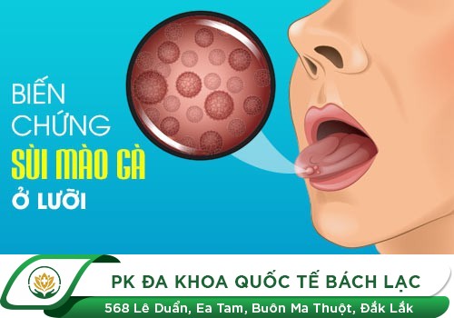 Những nguy hại từ bệnh sùi mào gà