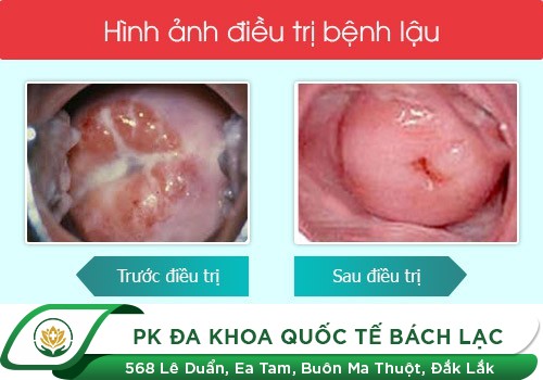 Điều trị bệnh lậu bao lâu thì khỏi