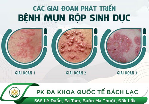 chảy mủ ở dương vật
