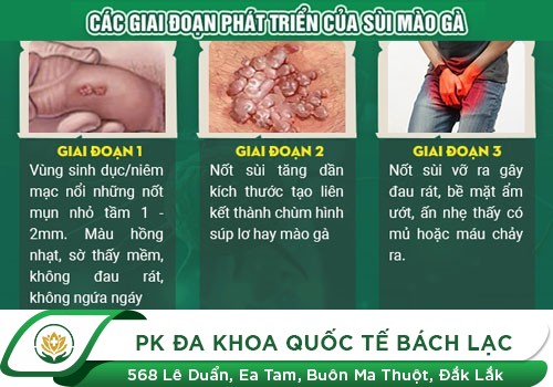 Biểu hiện của bệnh sùi mào gà như thế nào?