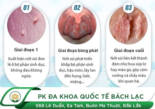 Hình ảnh bệnh mồng gà qua từng giai đoạn