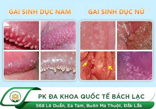 MỌC GAI Ở CƠ QUAN SINH DỤC LÀ BIỂU HIỆN CỦA BỆNH GÌ?