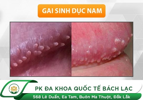 MỌC GAI Ở CƠ QUAN SINH DỤC LÀ BIỂU HIỆN CỦA BỆNH GÌ?