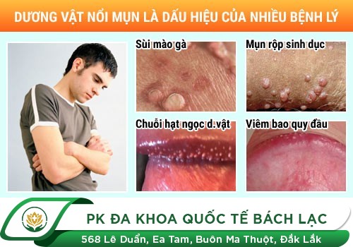 Lỗ sáo chảy mủ đau rát là dấu hiệu bệnh gì?
