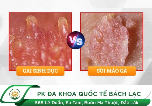 Cách phân biệt sùi mào gà và chuỗi hạt ngọc dương vật