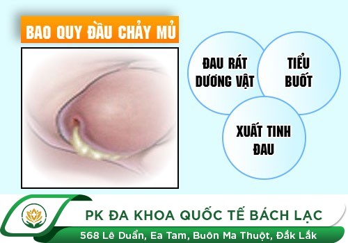 Nhận biết dấu hiệu lậu như thế nào?