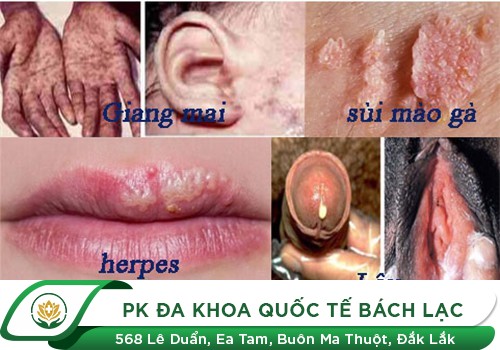 Bệnh lây truyền qua đường tình dục là gì?