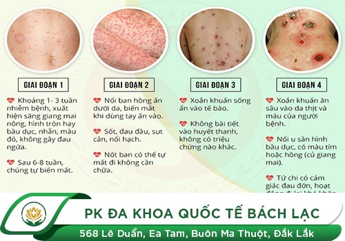Các giai đoạn của bệnh giang mai