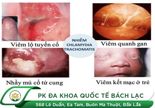 Bệnh Chlamydia
