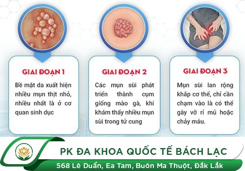 Khi nào cần đi khám bệnh sùi mào gà?
