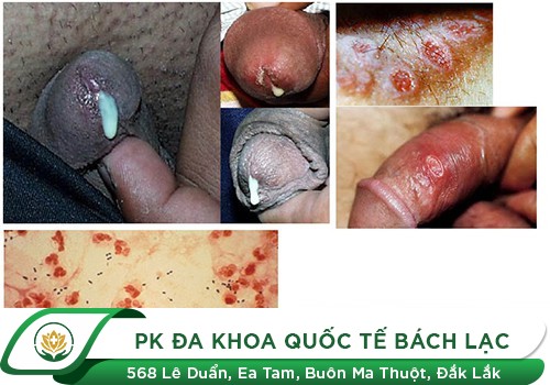  Bệnh lậu - Bệnh tình dục nguy hiểm hàng đầu hiện nay