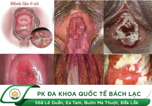 Hình ảnh bệnh lậu ở nam giới