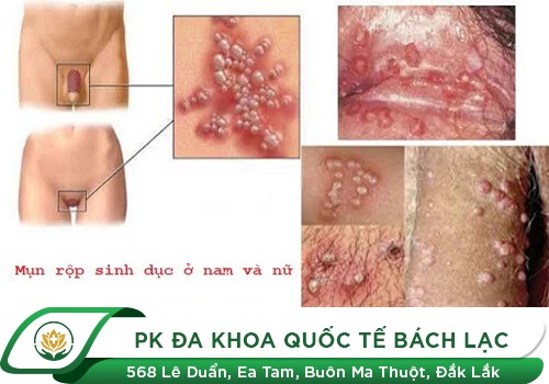 Hình ảnh bệnh mụn rộp sinh dục