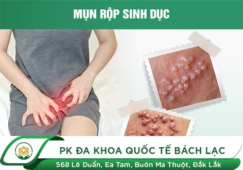 Dấu hiệu mụn rộp sinh dục ở nữ giới