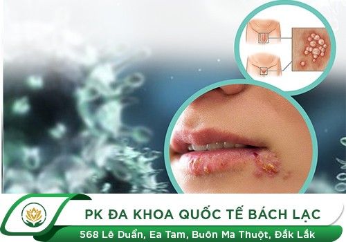 Mụn rộp sinh dục ở miệng rất giống với nhiệt miệng nên nhiều người dễ nhầm lẫn.