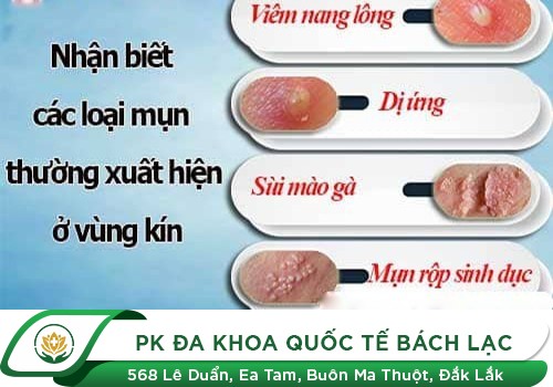 Mọc mụn thịt, mụn cóc, mụn nước ở bộ phận sinh dục nam là bệnh gì?
