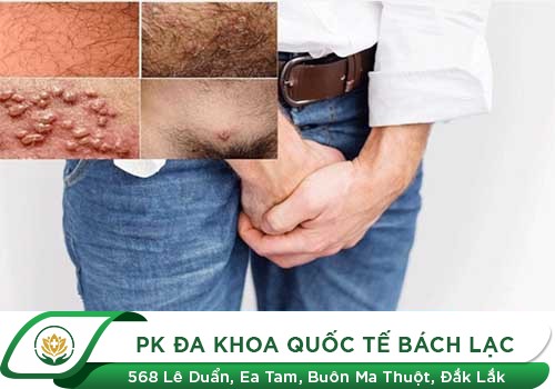 Dương Vật Nổi Mụn Li Ti Là Bệnh Gì?