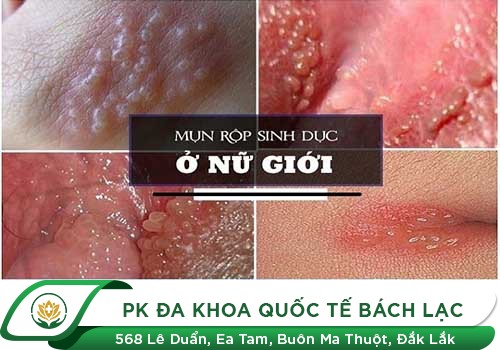 Nổi mụn âm đạo là dấu hiệu của bệnh gì?