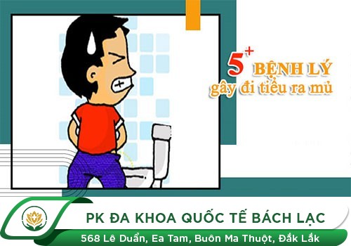 TIỂU RA MỦ - DẤU HIỆU NHẬN BIẾT CỦA BỆNH LẬU