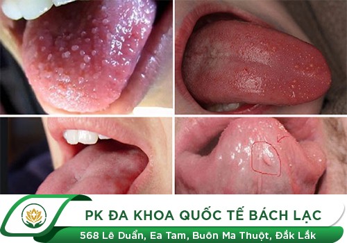 Bạn đã biết gì về sùi mào gà ở lưỡi