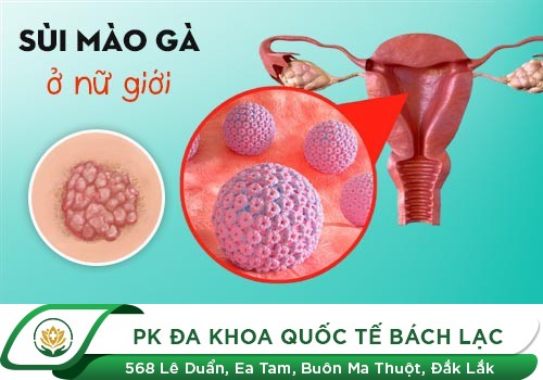 DẤU HIỆU NHẬN BIẾT SÙI MÀO GÀ