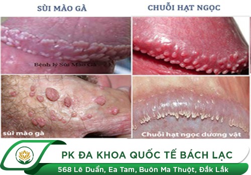 Cách điều trị chuỗi hạt ngọc dương vật