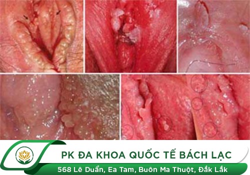 Bệnh Sùi Mào Gà 