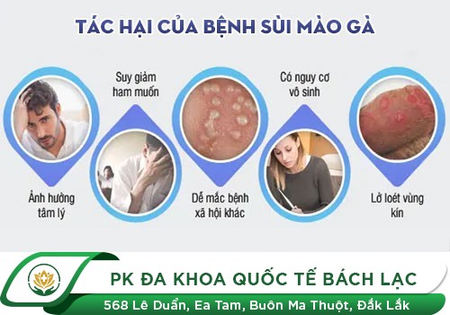 Một số hình ảnh về sùi mào gà
