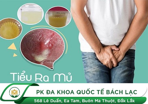 Đi tiểu bị buốt kèm theo có mủ là biểu hiện của bệnh gì?