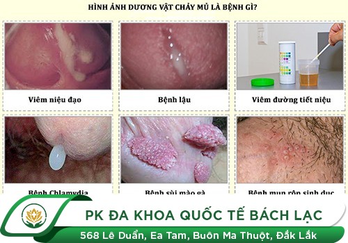 Tiểu ra mủ