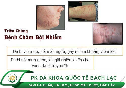 Nổi mụn ở bìu là dấu hiệu của bệnh lý gì?