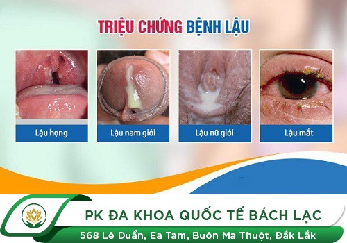Nam giới tiết dịch niệu đạo là bệnh gì?