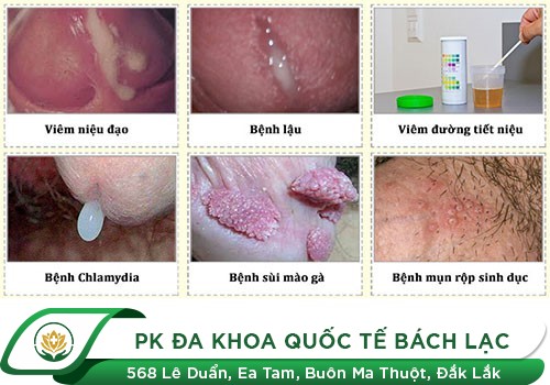 Lý giải nguyên nhân dương vật chảy mủ trắng 