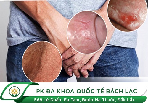 Sưng dương vật thì phải làm sao?