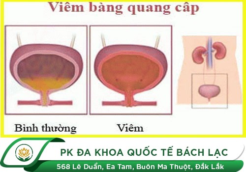 Viêm Bàng Quang Cấp Là Gì?