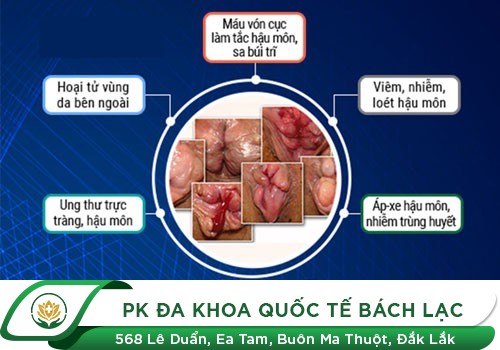 Bệnh Trĩ - E Ngại Đánh Mất Sức Khỏe Bản Thân!