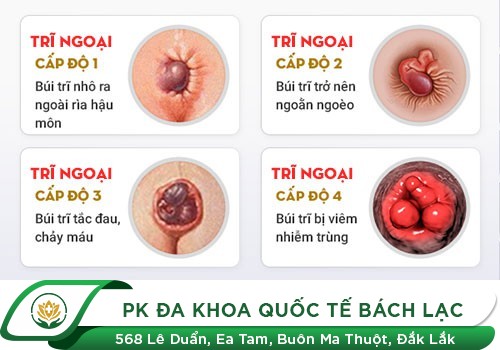 Trĩ Ngoại Nguy Hiểm Mức Nào Khi Không Kịp Chữa Trị