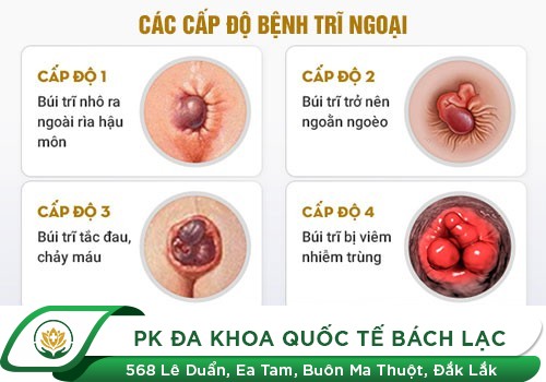 Bệnh Trĩ Ngoại – Dễ Nhận Biết Những Biến Chứng Khó Lường
