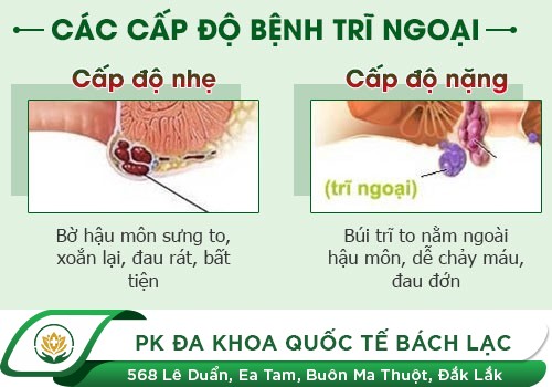 Bệnh Trĩ Ngoại Và Những Điều Cần Biết