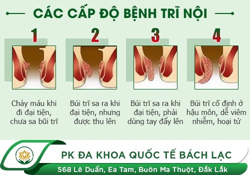 Phương Pháp Hỗ Trợ Điều Trị Bệnh Trĩ Nội Hiệu Quả