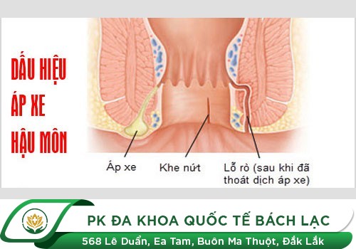 Dấu hiệu áp xe hậu môn như thế nào?