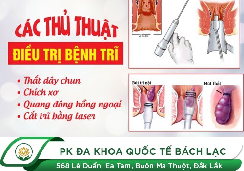 Cách Chữa Bệnh Trĩ An Toàn Và Hiệu Quả